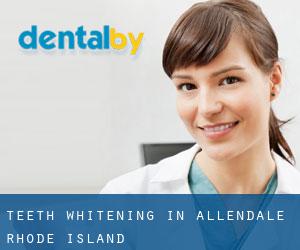 Teeth whitening in Allendale (Rhode Island)